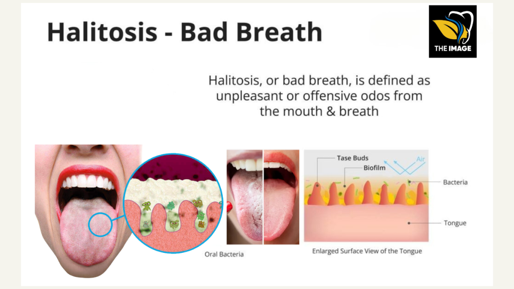 halitosis